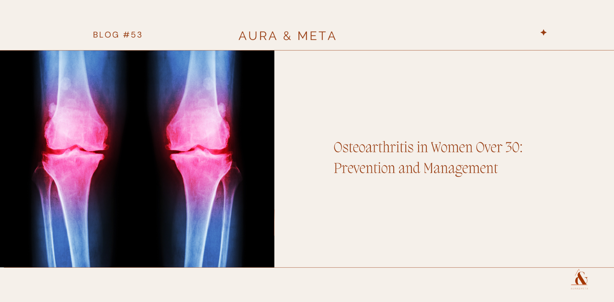 Osteoarthritis in Women over 30